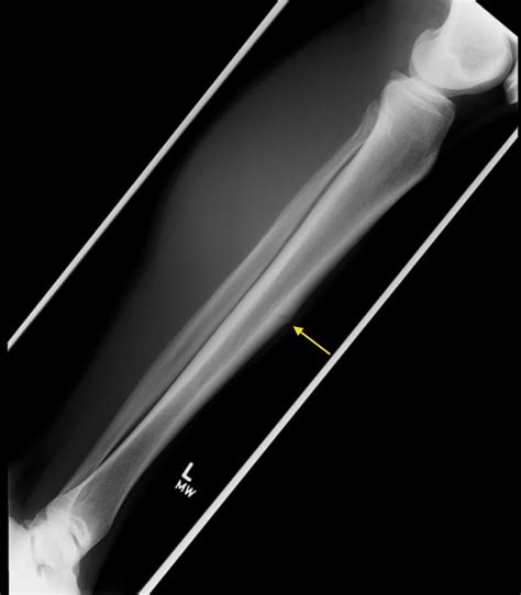 Stress Fracture Of Tibia Radiology At St Vincent S University Hospital