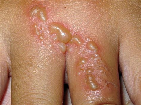 Skin Blister Medical Pictures Info Health Definitions Photos