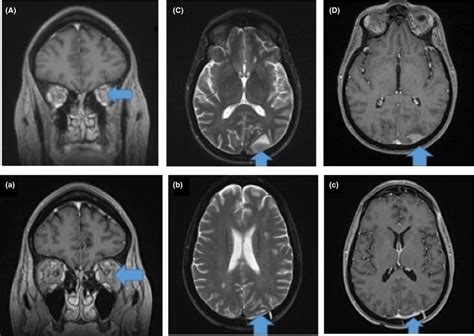 Brain Mri At Second Cns Relapse Showing Cranial Nerve Involvement