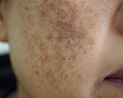 Melasma Treatment Cedars Dermatology Harley Street London