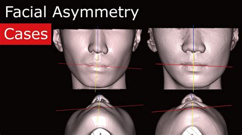 understanding facial asymmetry with an example youtube