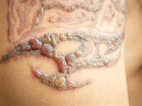 How Tattoos Are Removedeverything You Need To Know