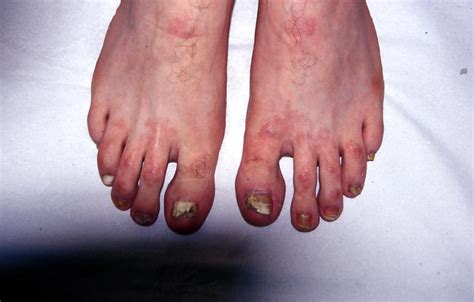 Nail Diseases Onychomycosis Picture Hellenic Dermatological Atlas