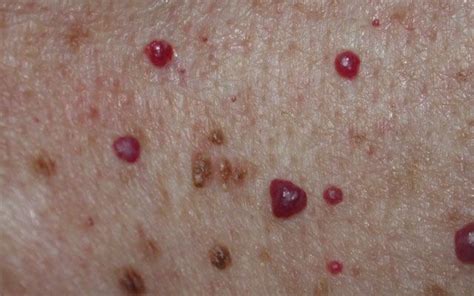 Blood Spots On Skin Dorothee Padraig South West Skin Health Care