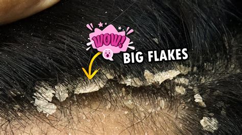 Removing Big Dandruff Flakes From Hair Dandruff Removal Satisfying