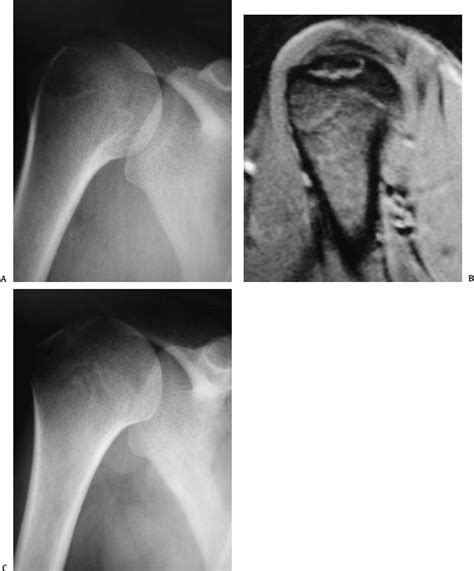 Cartilage Injuries In The Shoulder Musculoskeletal Key