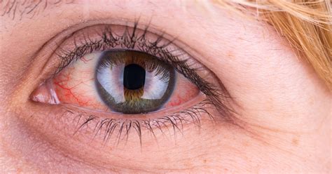 17 Red Eye Causes And How To Treat Red Eyes