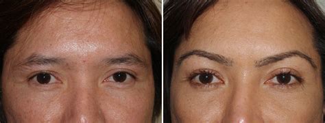 Patient 41363 Foundation For Hair Restoration