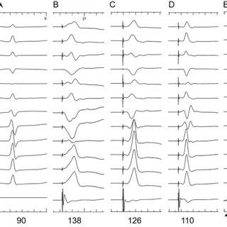 Twelve Lead ECG During Right Ventricular Apical Pacing In One Patient