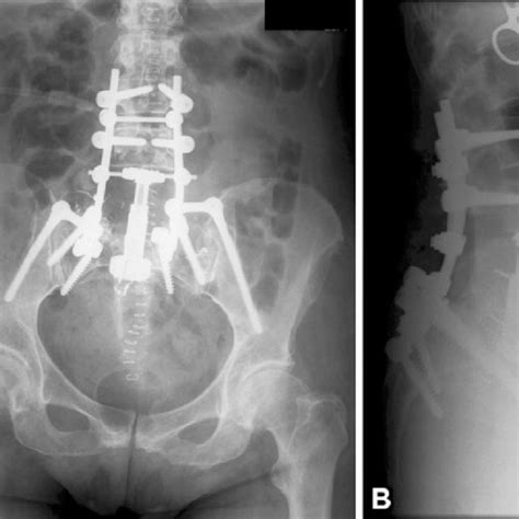 Final Anteroposterior A And Lateral B Radiographs Of The Pelvis