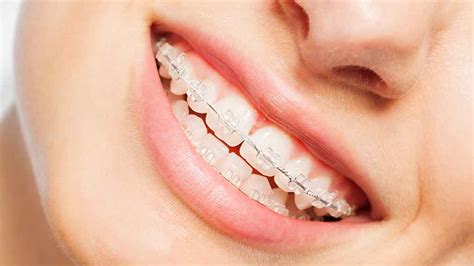 Dental and/or health insurance alone do not cover braces but you can get orthodontic insurance that specifically covers braces. Health insurance for braces - CHOICE