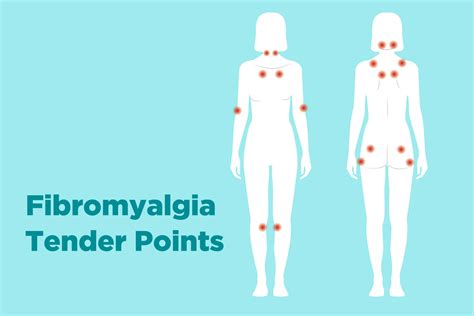 Trigger Points Fibromyalgia Chart