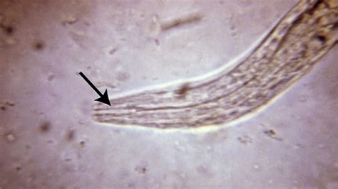 Parasitic Worms A Retro Cure For Autoimmune Diseases Fox News
