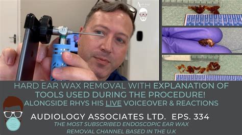 Hard Ear Wax Removal Explaining Tools Used During Procedure Ep 334