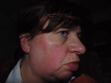 Lupus Butterfly Rash This S About Best Pic I Lupus Uk