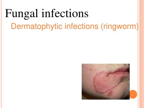 Ppt Fungal Infections Dermatophytic Infections Ringworm Powerpoint