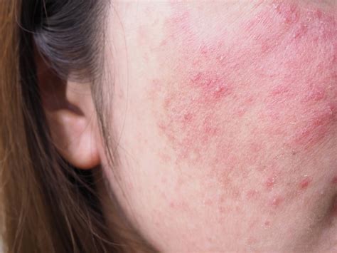 Premium Photo Red Rash On Young Woman Face Itchy And Allergic Skin