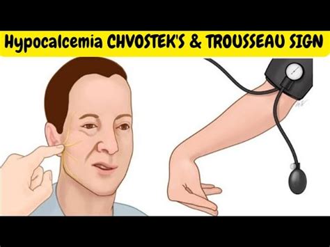 Hypocalcemia Signs And Symptoms Chvostek S Trousseau Sign Youtube