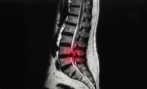 Spinal Stenosis