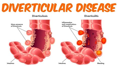 Diverticulosis And Diverticulitis Artofit