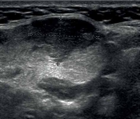 Para Aortic Lymph Node Ultrasound Images