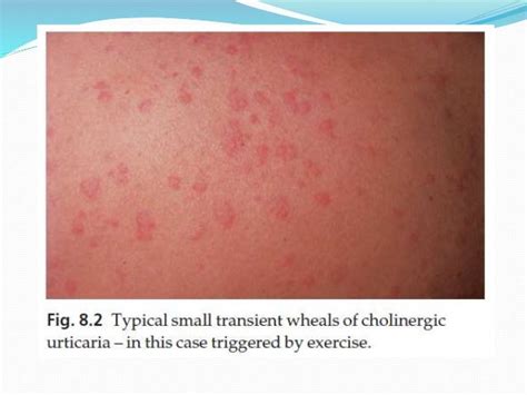 Urticaria Hives ‘nettle Rash