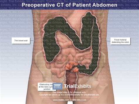 preoperative ct patient abdomen trial exhibits inc