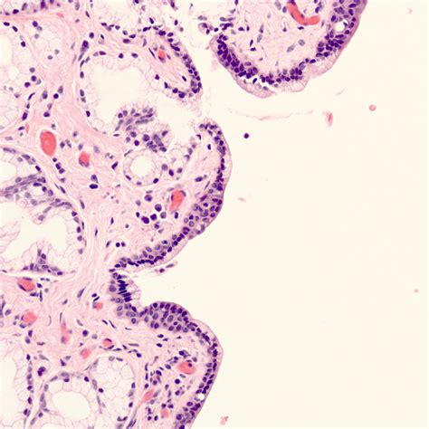 Pathology Outlines Vulvovaginal Cysts
