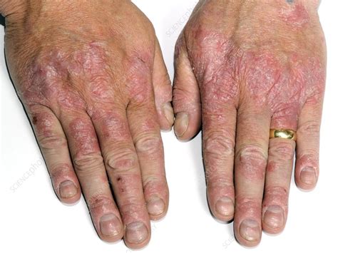 Psoriasis Of The Hands Stock Image C0238947 Science Photo Library
