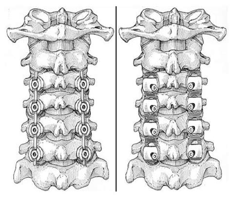 Lateral Mass Screws Fixation Of Cervical Spine موقع الاستاذ الدكتور محمد محي الدين