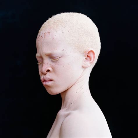 Abdel Sarune Mac We Are The World People Of The World Albino African