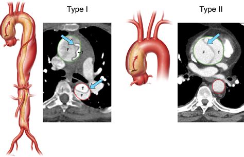 Contemporary Surgical Strategies For Acute Type A Aortic Dissection