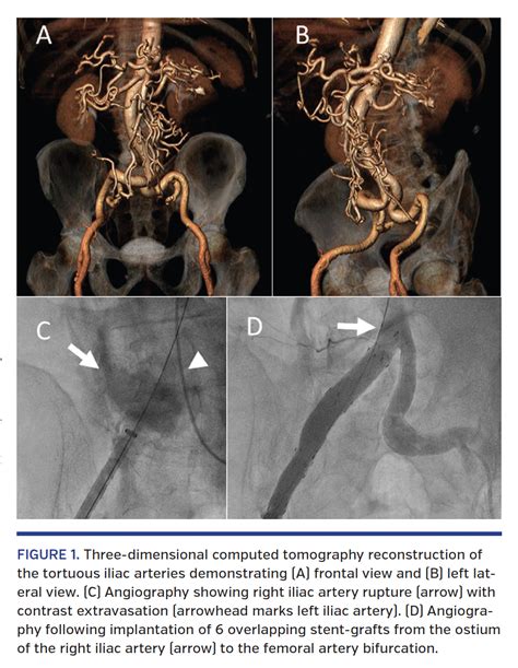 Iliac Artery Rupture During Transfemoral Transcatheter Aortic Valve
