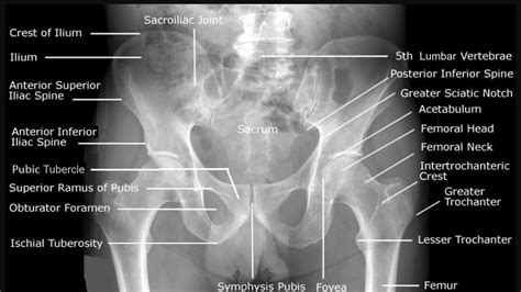 Cureus Impact Of Pelvic Bone Anatomy On Inguinal Hernia And The Role