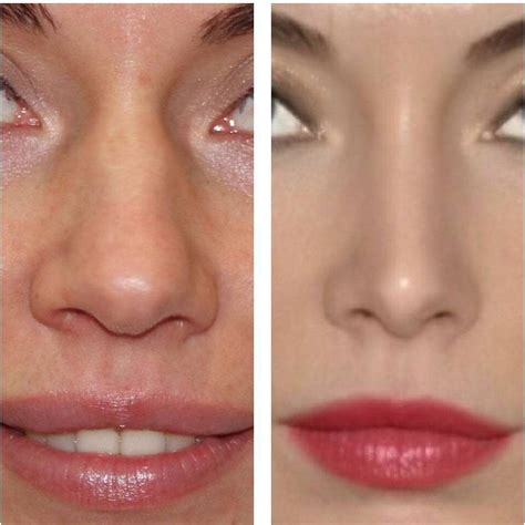 Nose Plastic Surgery Plastic Surgery Pictures Nose Surgery Botox Bulbous Nose Nose