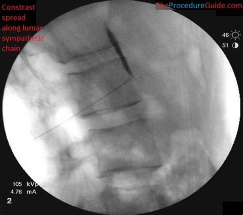 Fluoroscopic Guided Thoraciclumbar Medial Branch Radiofrequency