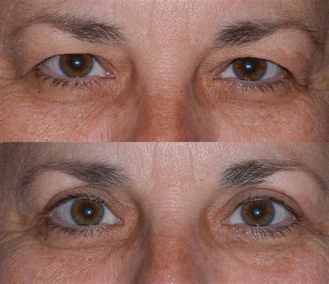Upper Blepharoplasty Before And After Center For Excellence In Eye Care