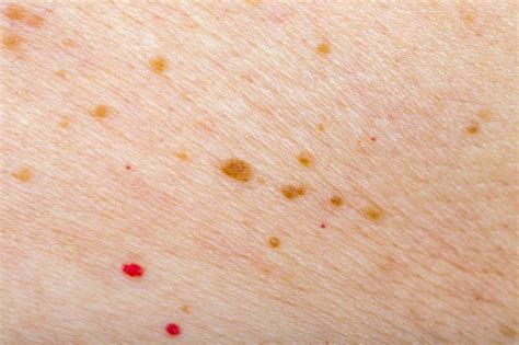 Tips To Prevent Red Moles On Your Body