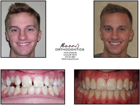 Before And After Masri Orthodontics