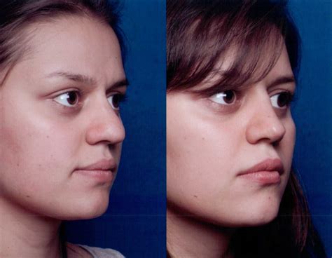 The Nose Clinic Before And After Nose Surgery Photos 60