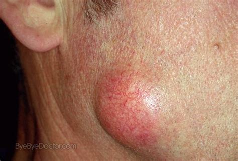 Epidermoid Cyst Pictures Treatment Removal Symptoms Causes