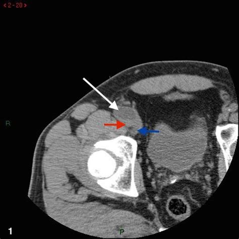 Paralabral Cysts Of The Hip Pacs