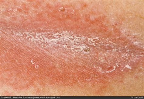 Stock Image Dermatology Psoriasis Rash In The Gluteal Cleft Of An