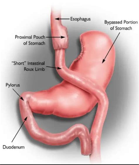 Roux En Y Gastric Bypass Anatomy