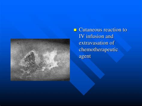 Ppt Part Ii Contact Dermatitis And Drug Eruptions Powerpoint