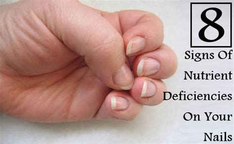 8 Signs Of Nutrient Deficiencies On Your Nails Fingernail Health You Nailed It Nails