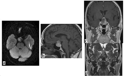 Brain Magnetic Resonance Imaging Scans A Diffusion Weighted Imaging