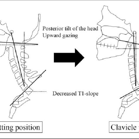 Radiographic Positioning For Evaluating Cervical Alignment A Patient