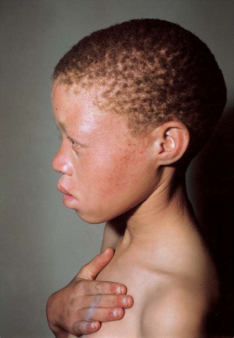 In Southern Africa Brown Oculocutaneous Albinism Boca Maps To The