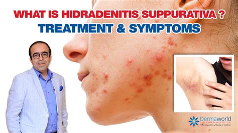 What Is Hidradenitis Suppurativa ¦ Treatment And Symptoms Dr Rohit